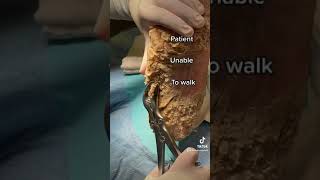 Severe Callus removal in operating room #Shorts