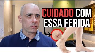 ÚLCERA VARICOSA, O QUE FAZER? | Dr Dayan Siebra