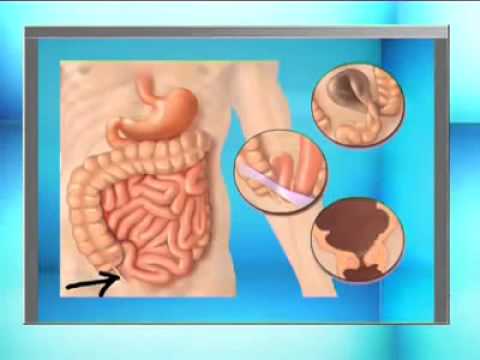 comment soulager une occlusion intestinale