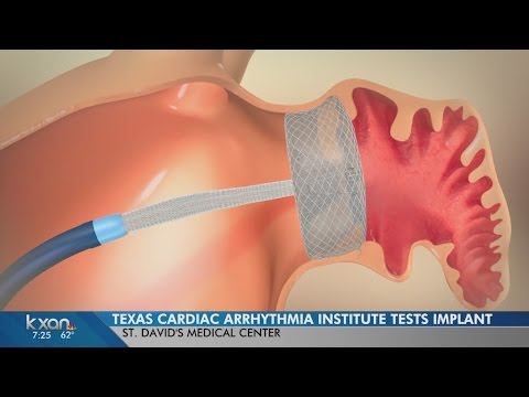 Texas cardiac arrhythmia institute tests new implant