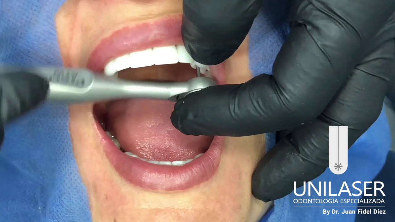 Unilaser | Paso a paso Implantes, Coronas en Zirconio y Carillas en Porcelana