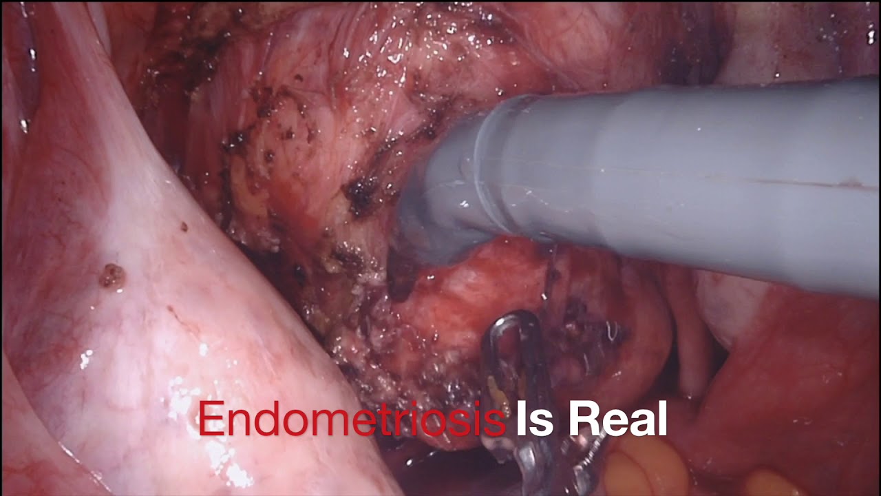 Pelvic Pain, Dysmenorrhea, Infertility : Endometriosis Robotic Excision