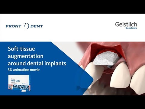 Hogyan helyezzük be a Geistlich Fibro Gide®-ot