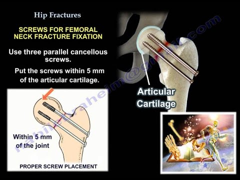 Hip Fractures - Everything You Need To Know - Dr. Nabil Ebraheim
