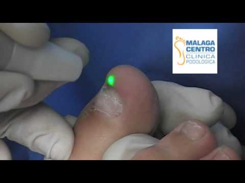 Ekzoderil para la ingle Las pastillas del hongo de las uñas en las manos como aceptar