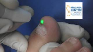 Tratamientos láser para los hongos en las uñas por su Podólogo en Málaga