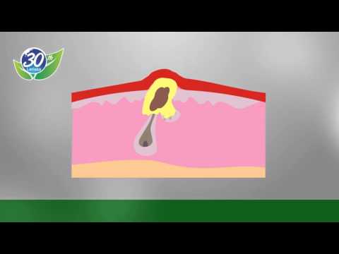 Apakah mungkin untuk acar salad untuk menurunkan berat badan Berat musim dingin