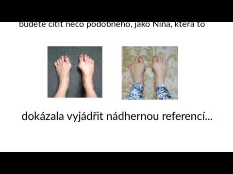 Koślawego zamiar kupić w aptece w Nowosybirsku Jak pozbyć się stłuczki na dużych palcach środków ludowej