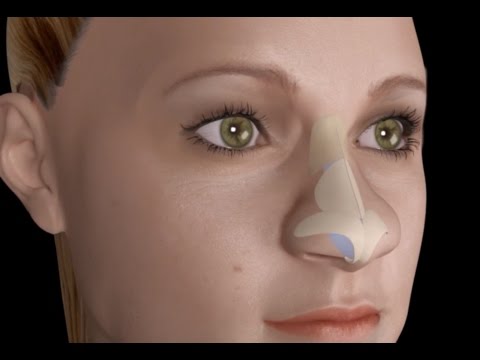 Bulbous Large Nasal Tip Nose Job Rhinoplasty