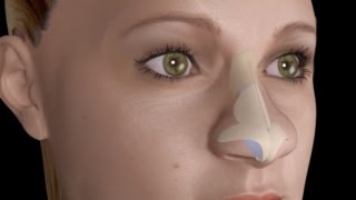 Bulbous Large Nasal Tip Nose Job Rhinoplasty