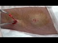 Rockport S Lipoma Cysts Pimples Blackheads Acne