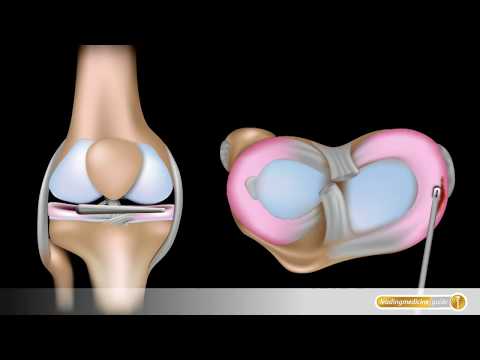 Kniegelenk: So werden Meniskusschäden minimal-invasiv operiert