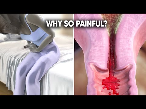Thumbnail for: Why Period Cramps Hurt So Much and How to Fix Them