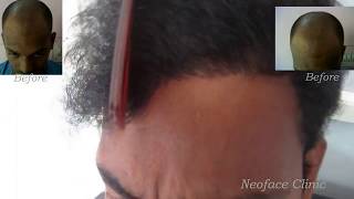 preview picture of video 'Dense hair growth after FUE Hair transplantation by Dr. Uroof @ neoface clinic'