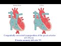 congenitally corrected transposition of the great arteries cctga wth ebstein anomaly left side tv