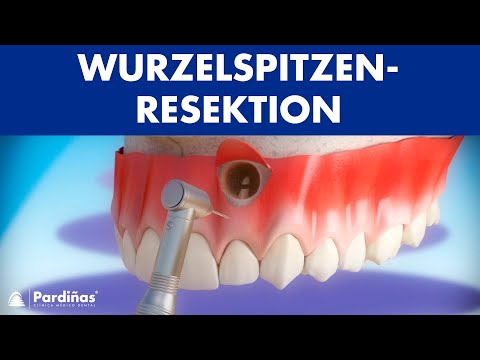 Wurzelspitzenresektion ©