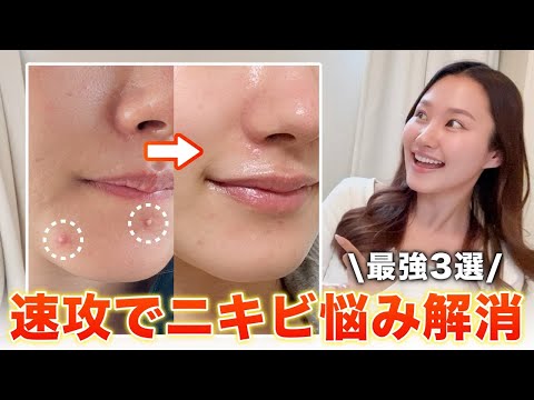 【リアル】急遽できたニキビにはコレやっとき