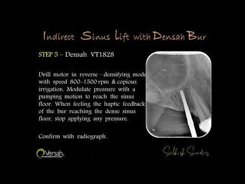 Indirect Sinus Lift