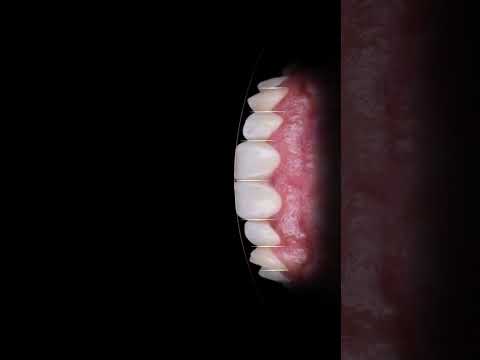 نتائج — الحشو التجميلي