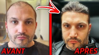 Adieu la calvitie - je retrouve mes cheveux 