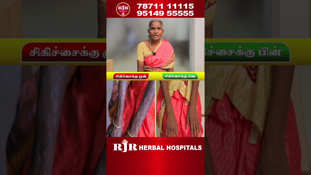 சொரியாசிஸ் தோல் நோய் சிகிச்சை (PSORIASIS)