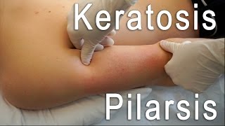 Keratosis Pilaris Clear + Brilliant Treatment FT. Eric Smith | BLUSH Beverly Hills