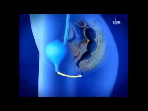 Kalanchoe Prostatabehandlung BPH Essen zu einem Adenom