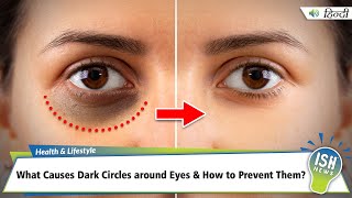 What Causes Dark Circles around Eyes and How to Prevent Them?