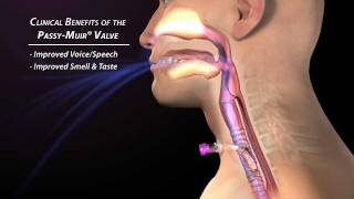 Product video: Passy Muir Tracheostomy, Ventilator Swallowing & Speaking Valves