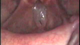 Smoker's polyps / Reinke's edema