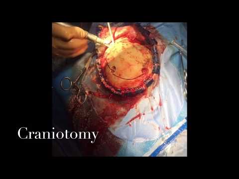 Evacuation of Acute Subdural Hematoma