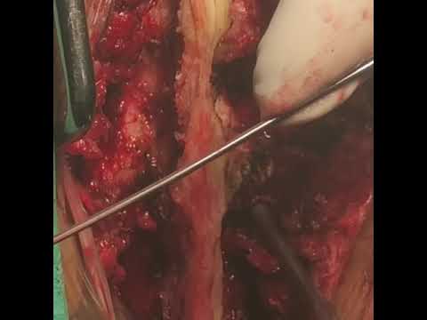 Technique of insertion of pedicle screws