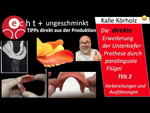 Optimieren d. Prothesenhaltes Teil 2 - im Unterkiefer durch Erweiterung von paralingualen Flügeln