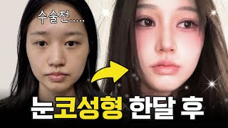 성형하고 여돌비주얼 완성✨ 솔직히 자려한 코가 이번 수술의 킥이죠❤️ (눈재수술,첫코수술,매부리제거)