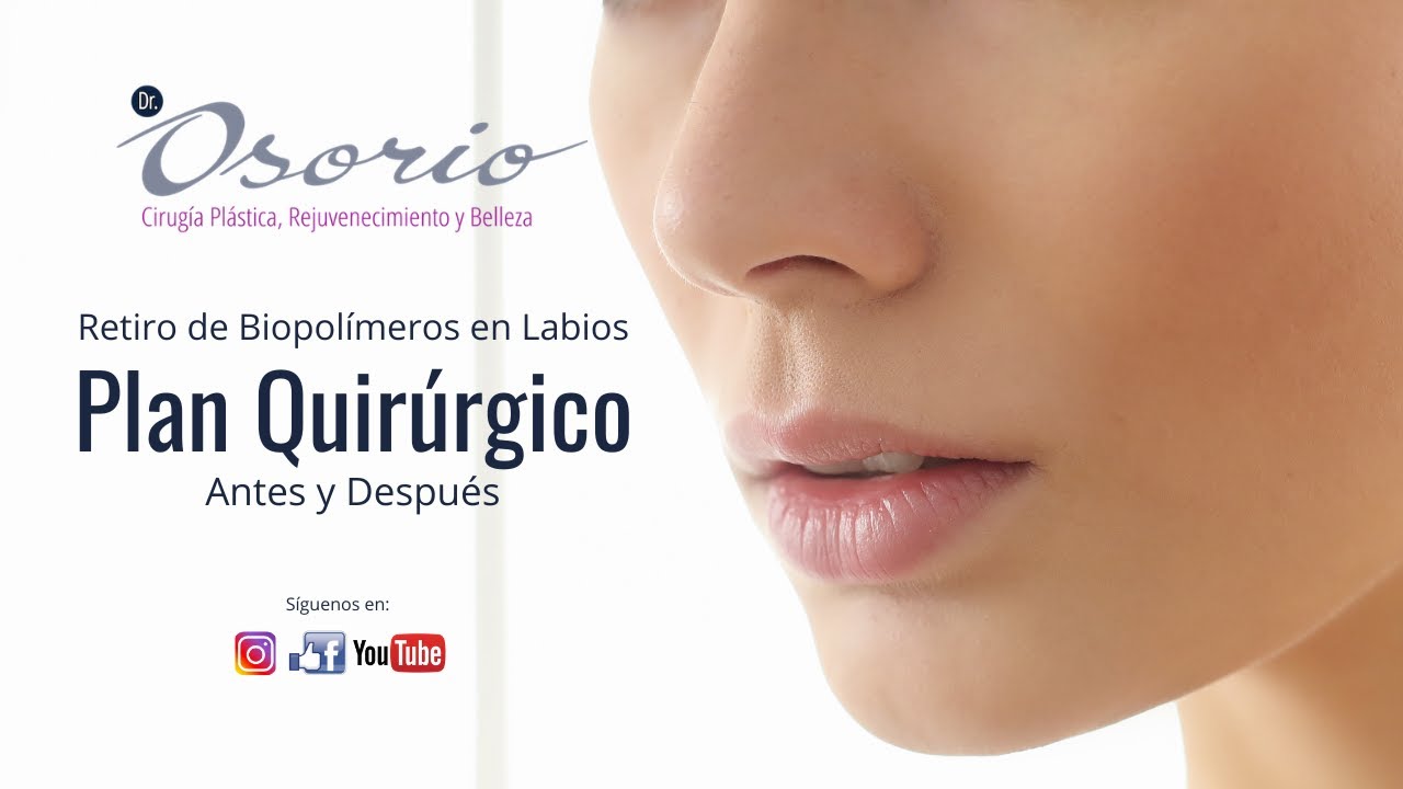 Retiro de biopolímeros en labios / Plan quirúrgico.