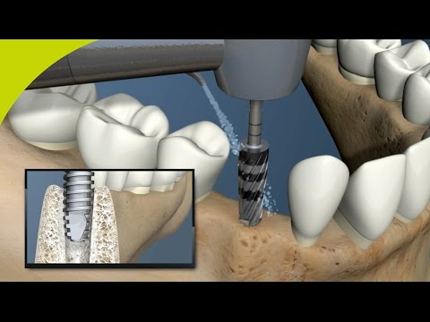 Versah Densah Bur Introduction Animation Video