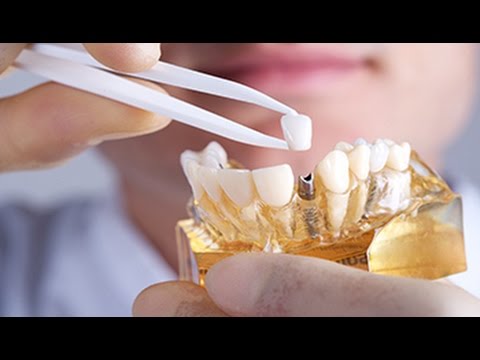 Dental Implants Chatswood (02) 8090 1106 | The Best Dental Implants in Chatswood