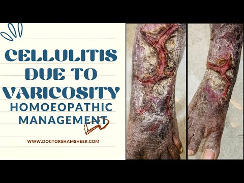 Cellulitis due to varicosity