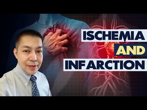 ECG Myocardial Ischemia and Infarction