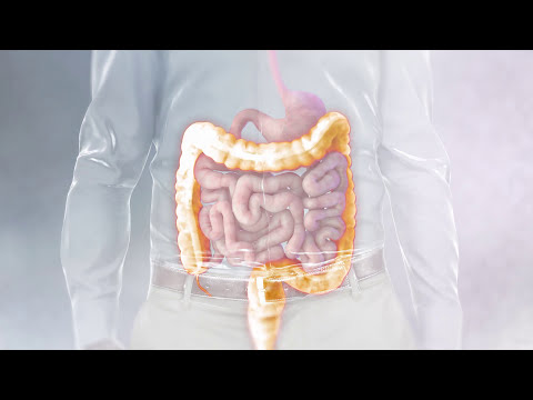 Understanding the J-pouch surgical procedure