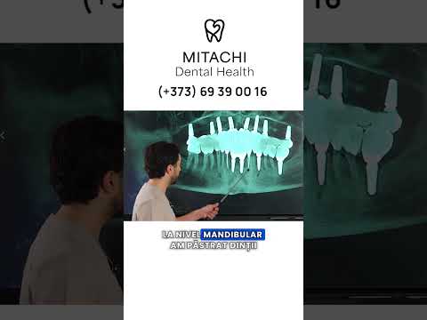 Accident grav la schi. Zâmbet refăcut Accident - tratament cu Dinți Ficși