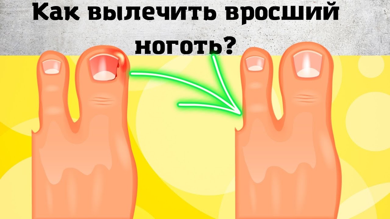 6 СПОСОБОВ Как Быстро и Легко Исправить Вросшие Ногти на Ногах