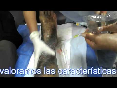 Curación de una herida  ùlcera varicosa