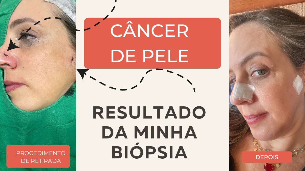 CÂNCER DE PELE INÍCIO MEU CASO REAL