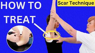 Improve Arm Movement After Breast Cancer Treatment: Techniques for Health Professionals