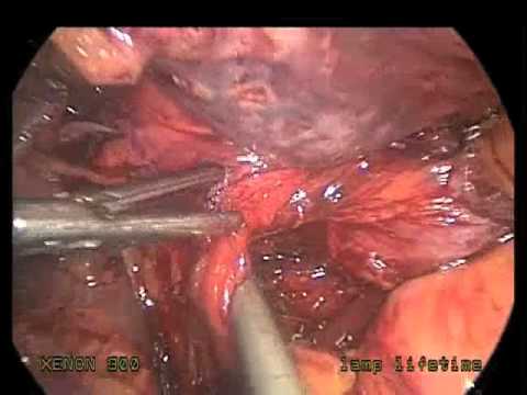 Laparoskopowa resekcja dystalnej części przełyku i pouch żołądka z powodu nowotworu połączenia przełykowo-żołądkowego