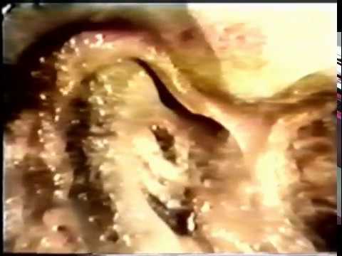 Articolazioni del ginocchio prezzo Mal di gola nel mezzo del collo fa male a deglutire