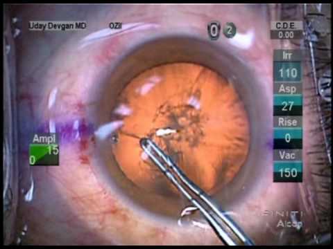 Cataract Surgery - Zeiss Lumera Microscope