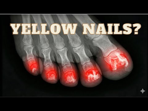 ⚠️ - Why Fungus Comes Back ❌- (Its Not Your Hygiene)