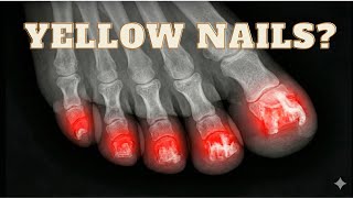 ⚠️ - Why Fungus Comes Back ❌- (Its Not Your Hygiene)